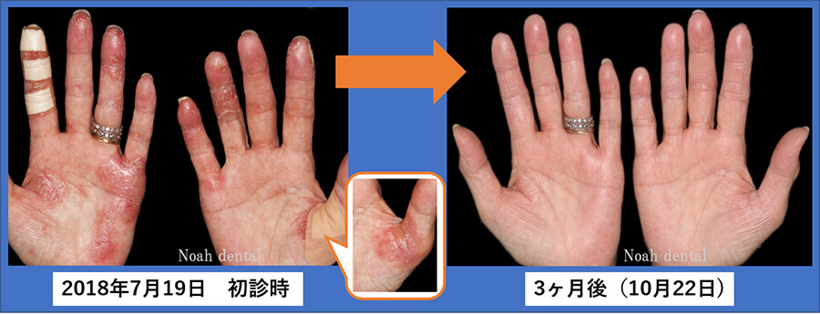 お口の金属を除去することで、症状改善される方がいます