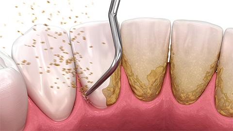 専門器具でのプラーク、歯石の除去