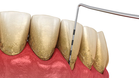 歯周病検査