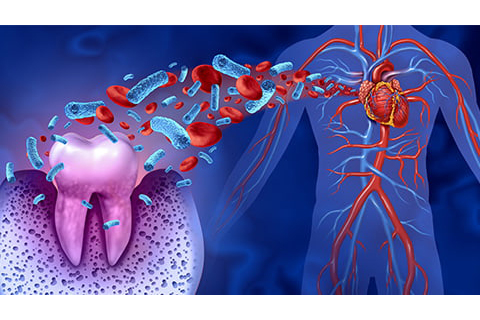 歯周病原菌が全身をめぐる