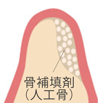 GBR骨造成2回法